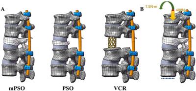 Biomechanical and clinical evaluation of PSO, modified PSO and VCR treating OVCF kyphosis: a finite element analysis